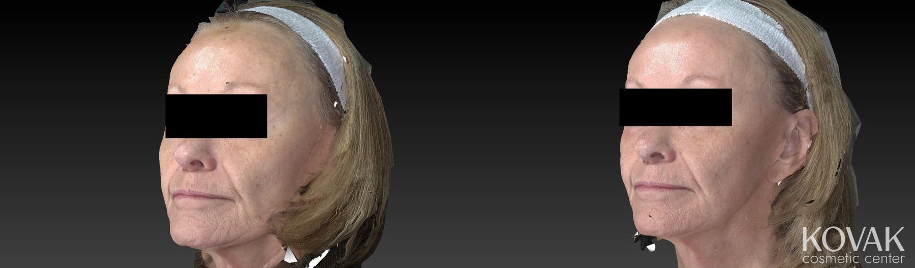 Before and after Halo™ case 36482 - Angle 3