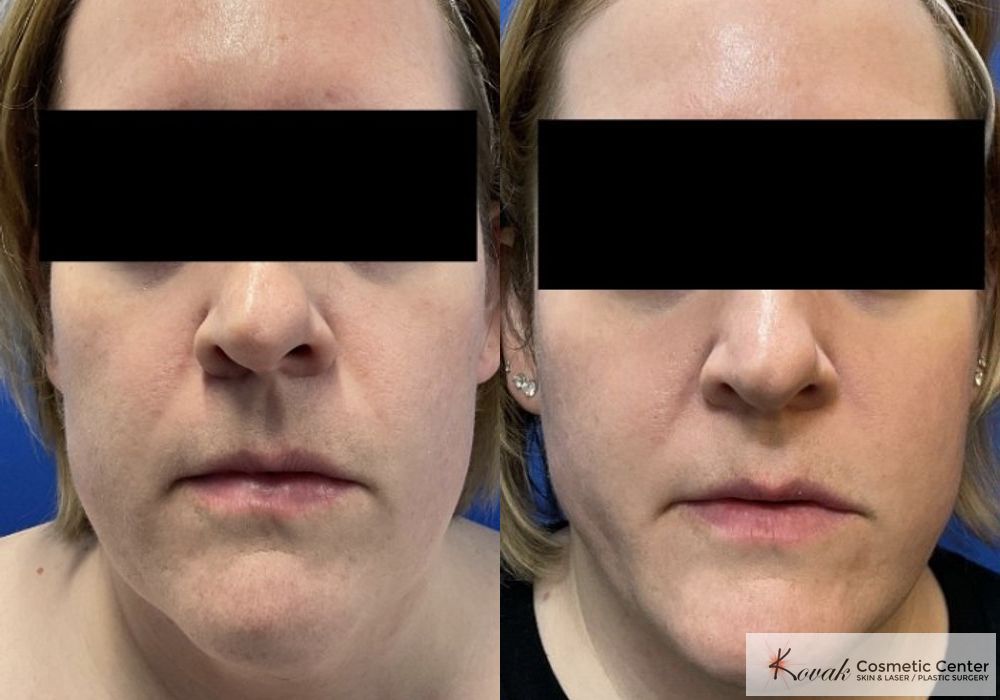 VLR - Vaser Laser - Jawline Sculpting - Case 1558