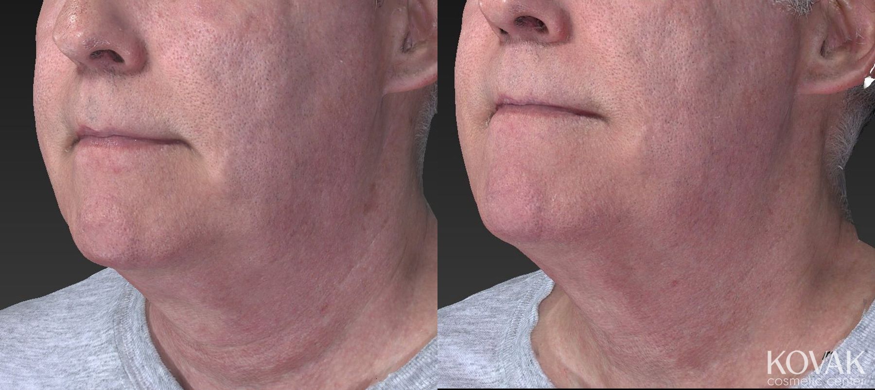 Before and after Kybella case 36640 - Angle 3