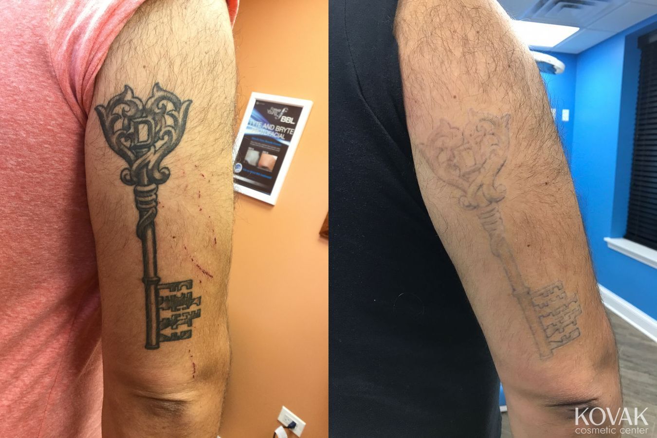 Before and after Tattoo Removal case 36552