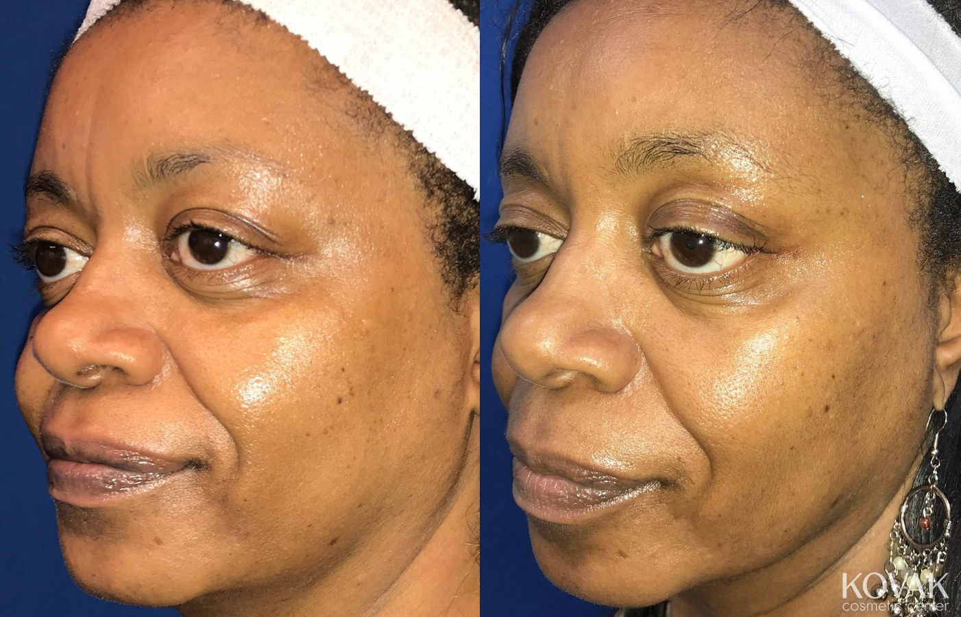 Before and after Lip Augmentation case 36563 - Angle 2