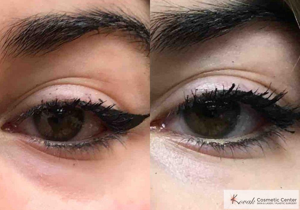 Eye Treatments - Thumbnail 2