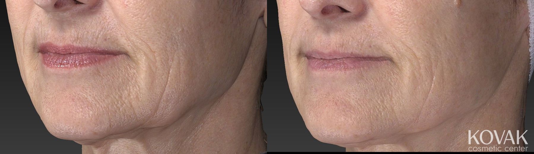 Before and after Restylane® Silk case 36462 - Angle 4