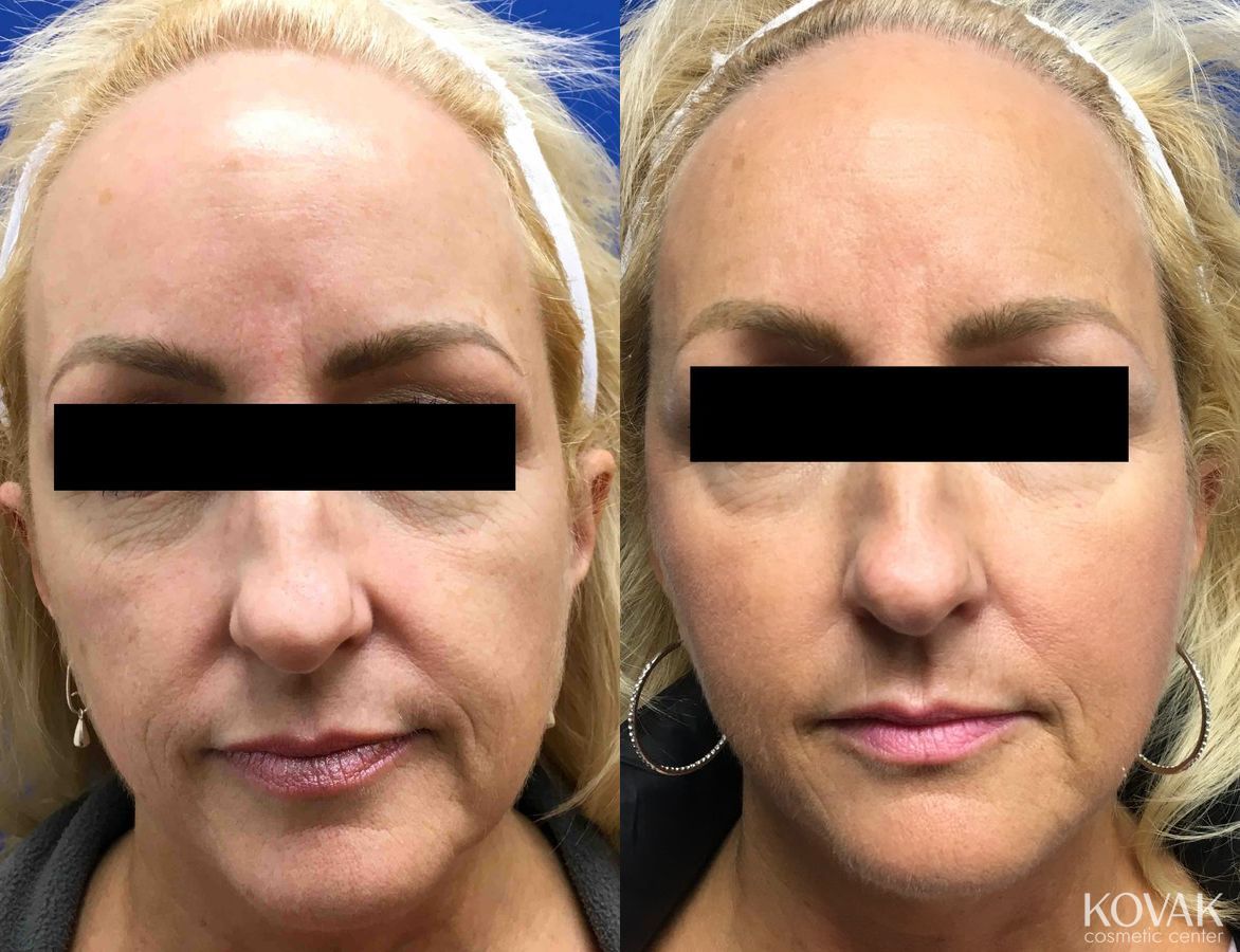 Before and after Injectables - Face case 36671