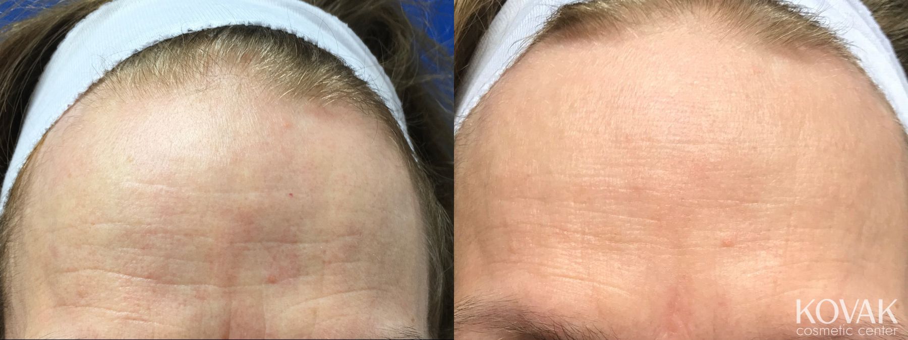 Before and after Forehead Lines case 36449