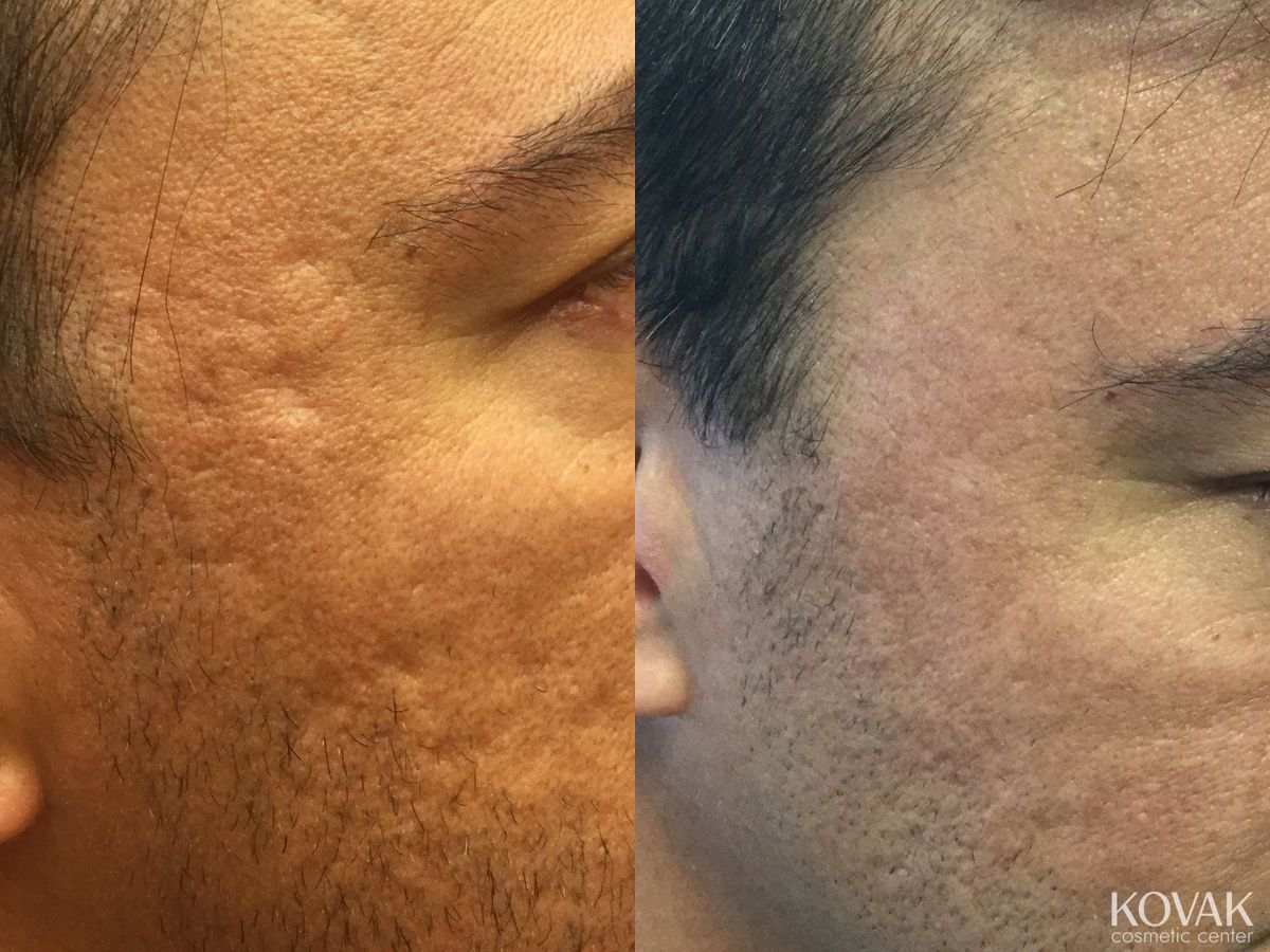 Before and after Acne Scars case 36614 - Angle 2
