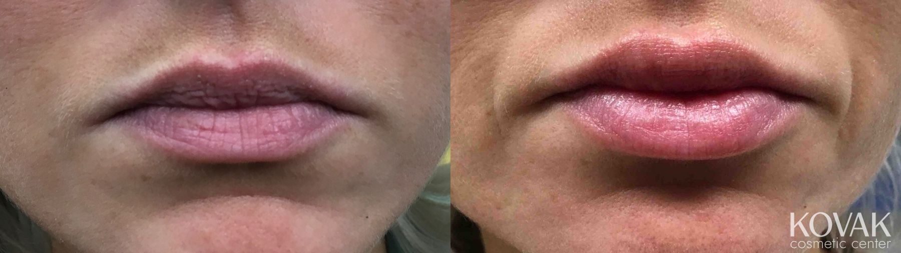 Before and after Lip Augmentation case 36657