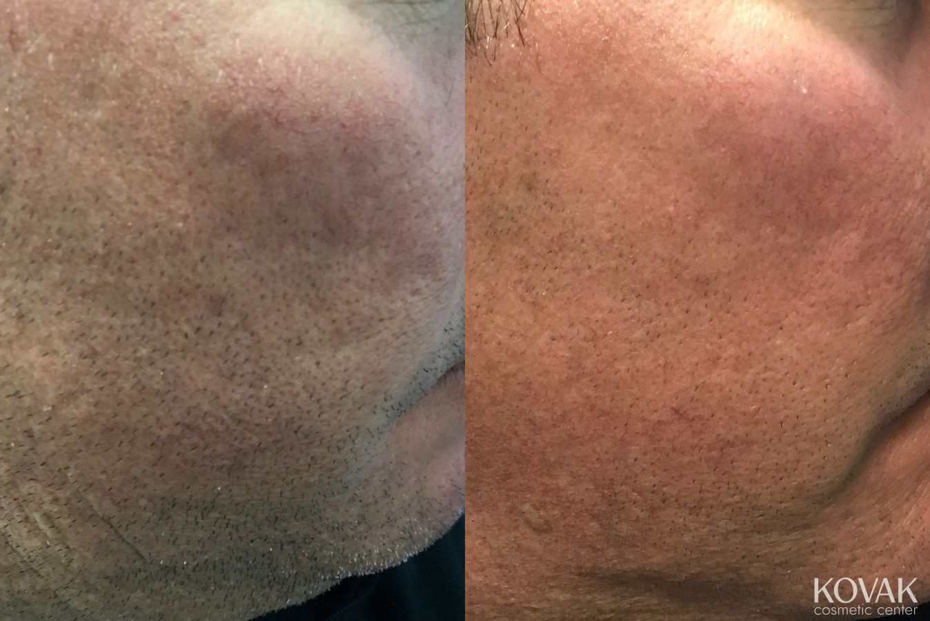Before and after Acne Scars case 36458