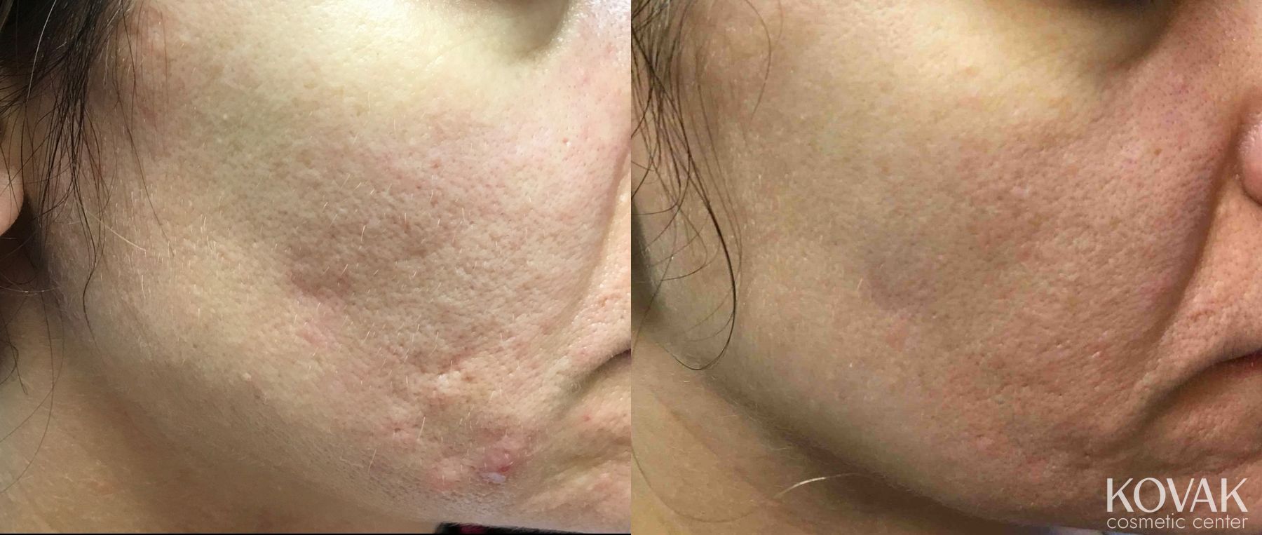 Before and after Acne Scars case 36617 - Angle 2