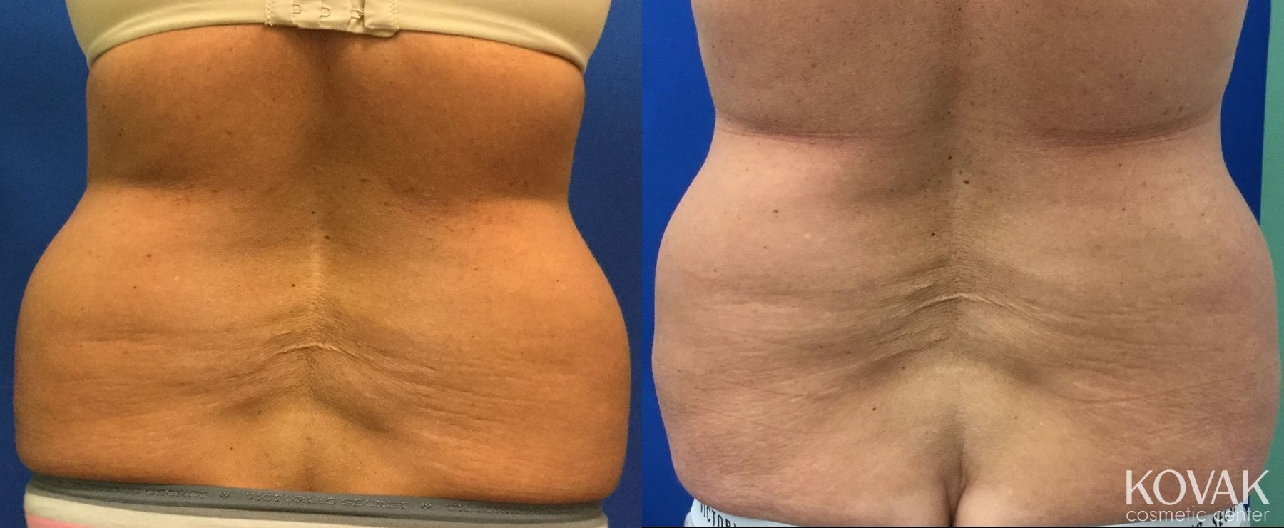 Before and after CoolSculpting® case 36465 - Angle 4