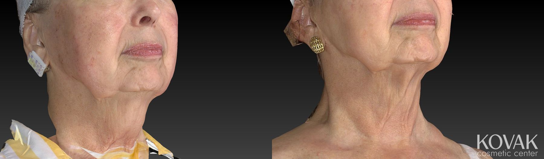 Before and after Kybella case 36525 - Angle 2