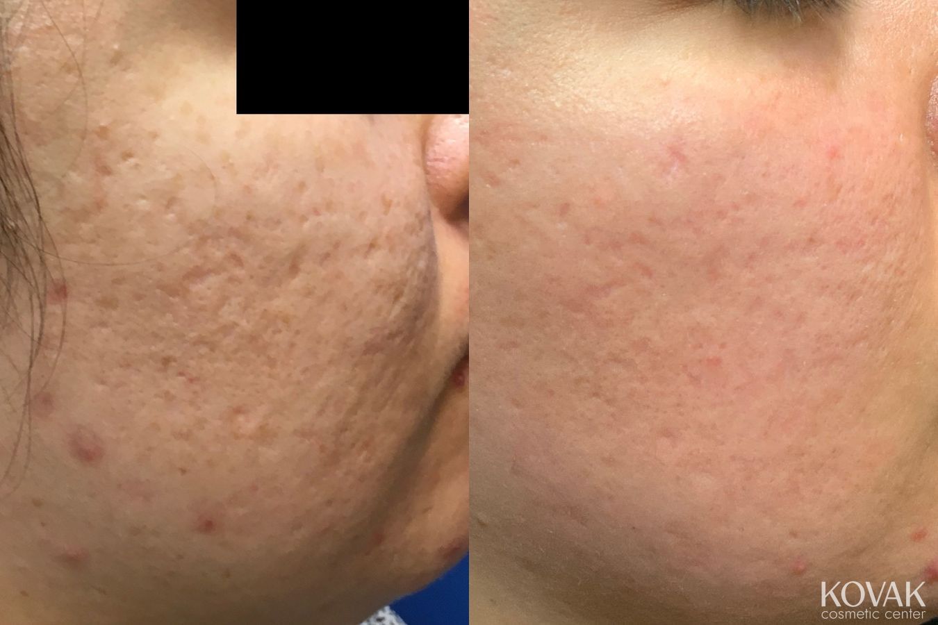 Before and after Acne Scars case 36693