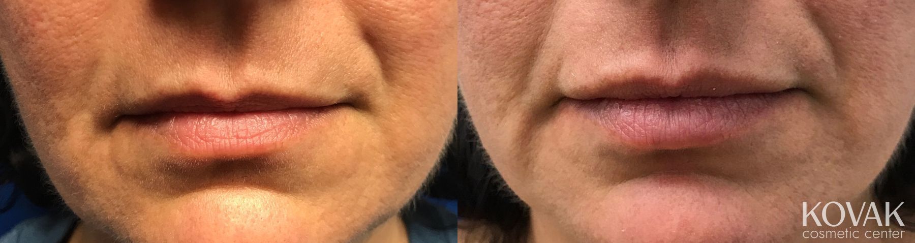 Before and after Juvéderm® XC case 36574
