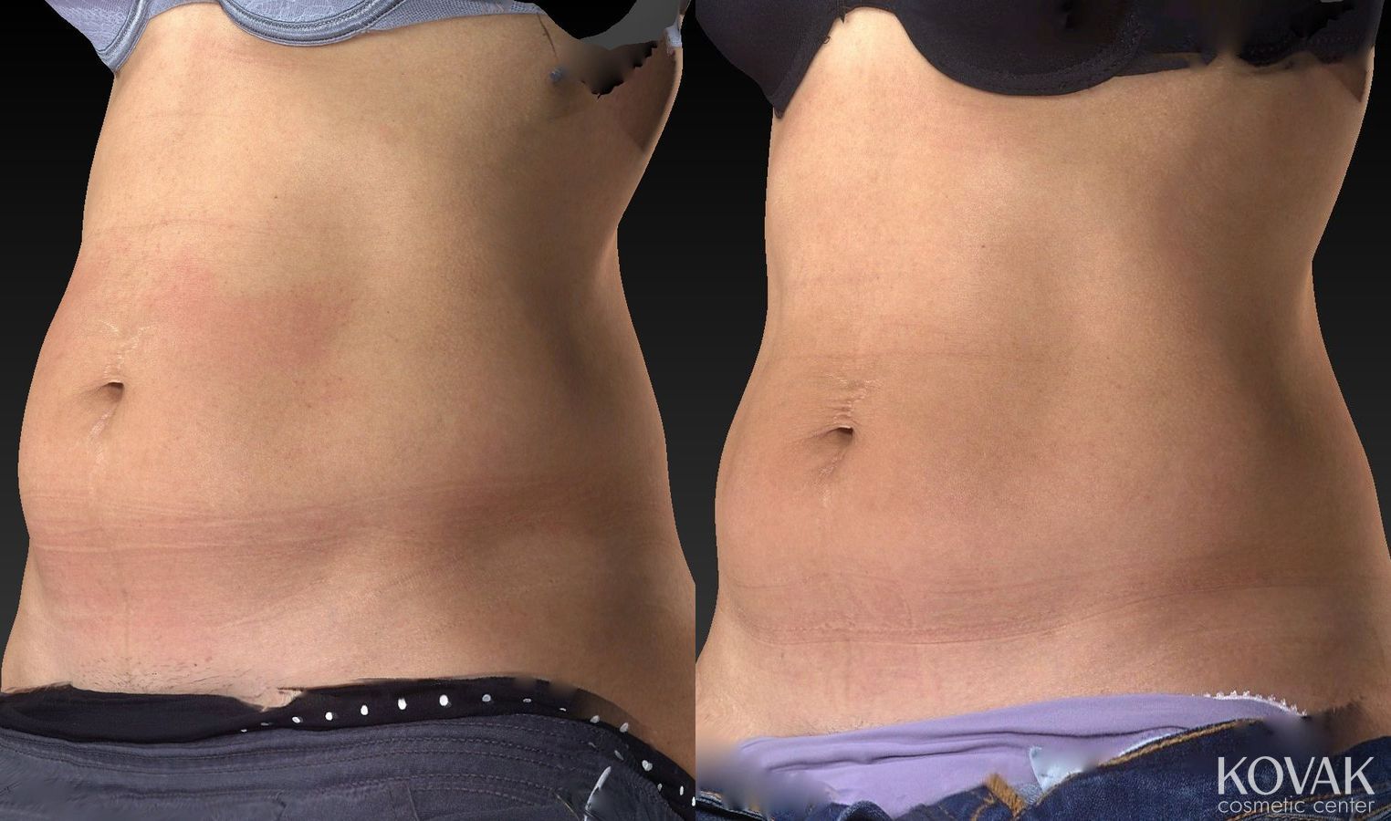 Before and after CoolSculpting® case 36479 - Angle 4