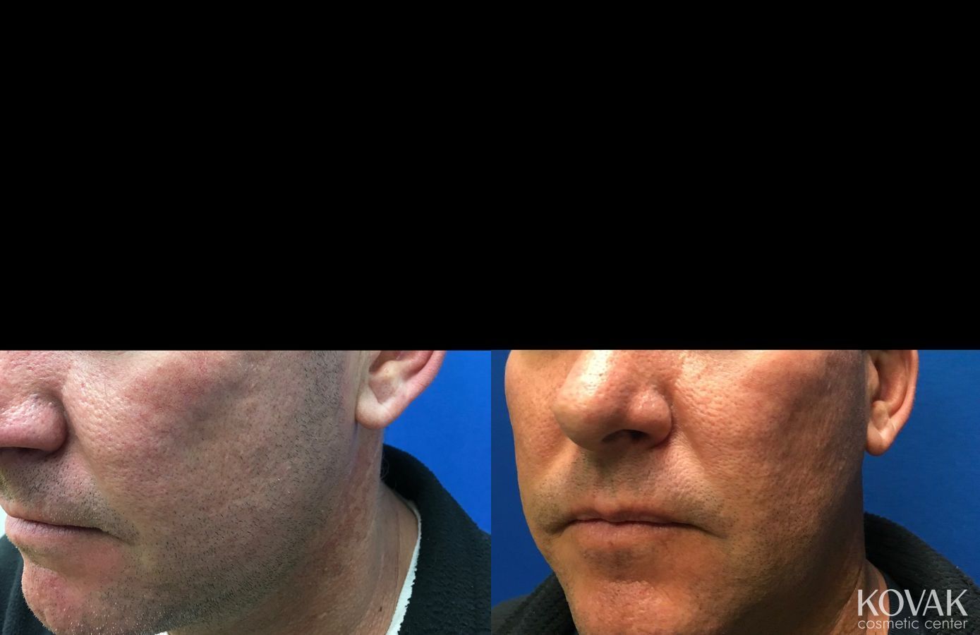 Before and after Juvéderm® XC case 36463 - Angle 2