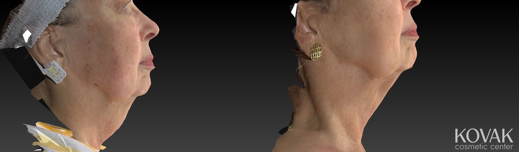 Before and after Kybella case 36525