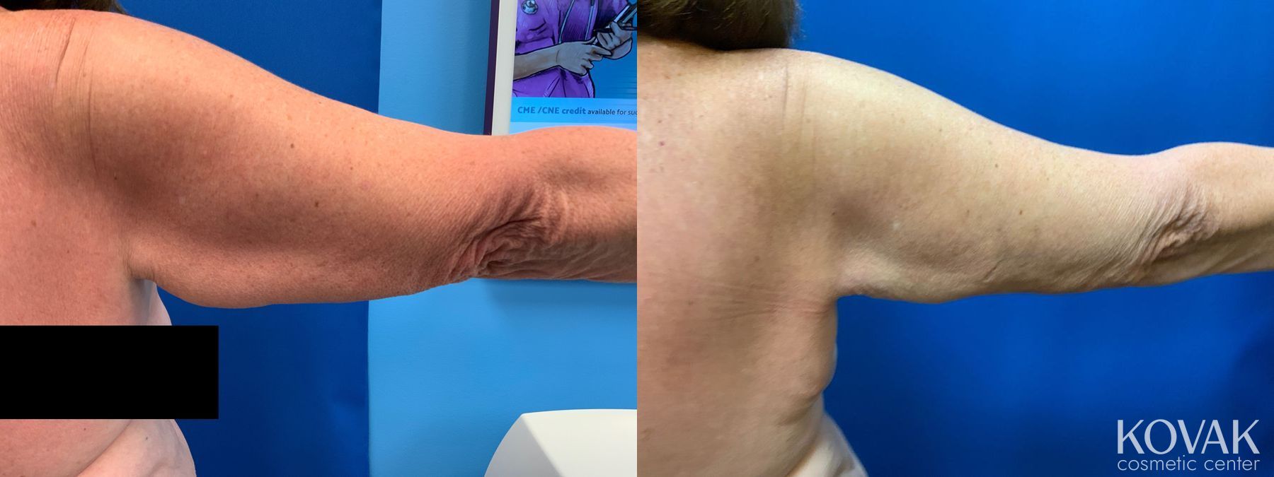 Before and after Laser Liposuction case 36699