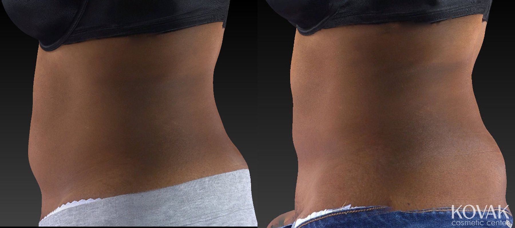 Before and after CoolSculpting® case 36505 - Angle 4