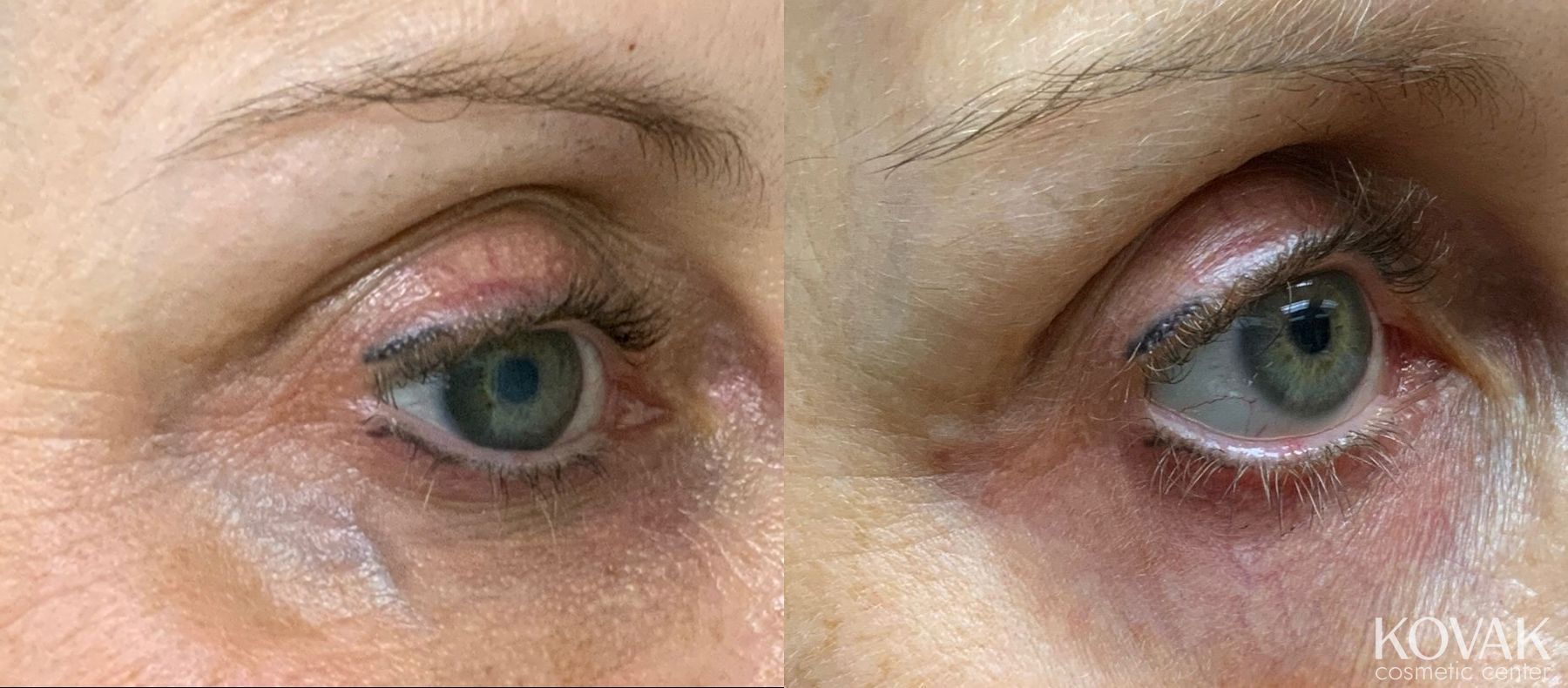 Before and after Eye Vein Treatment case 36696