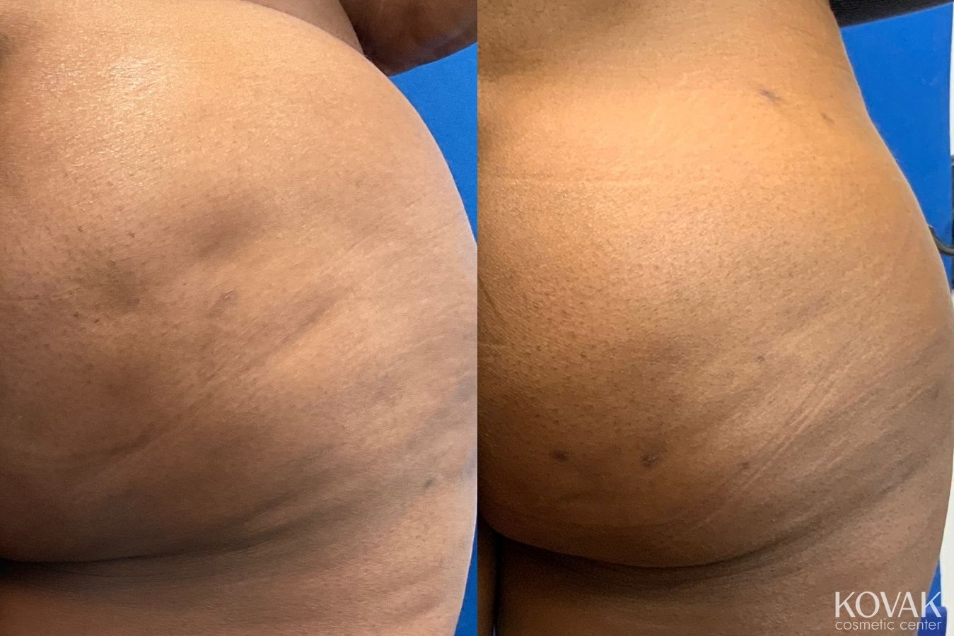 Before and after Cellulite Reduction case 36701 - Angle 2