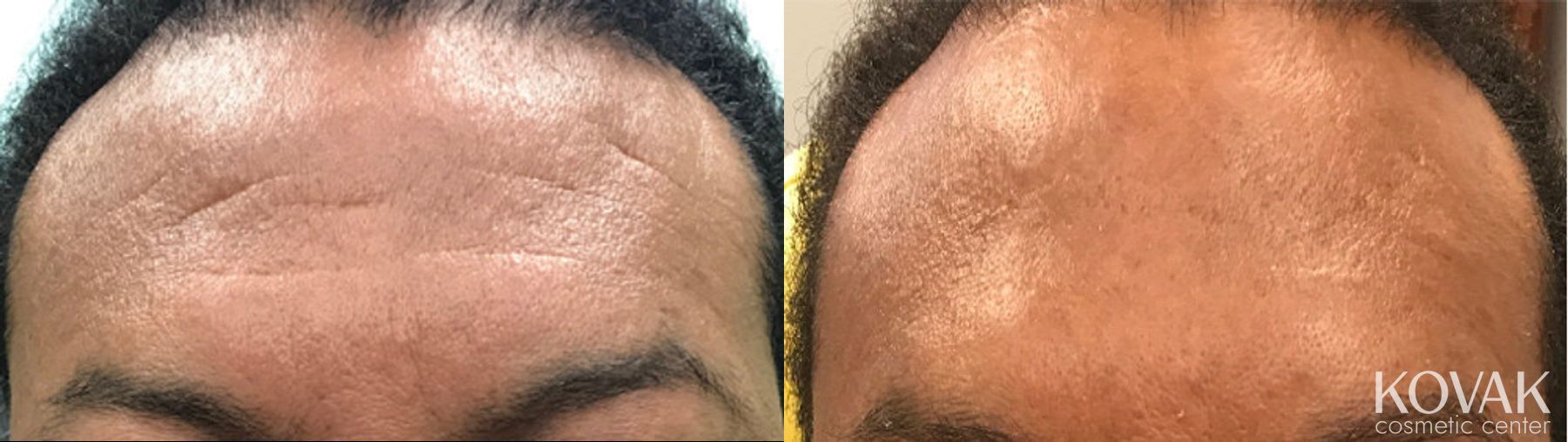 Before and after Restylane® Silk case 36507