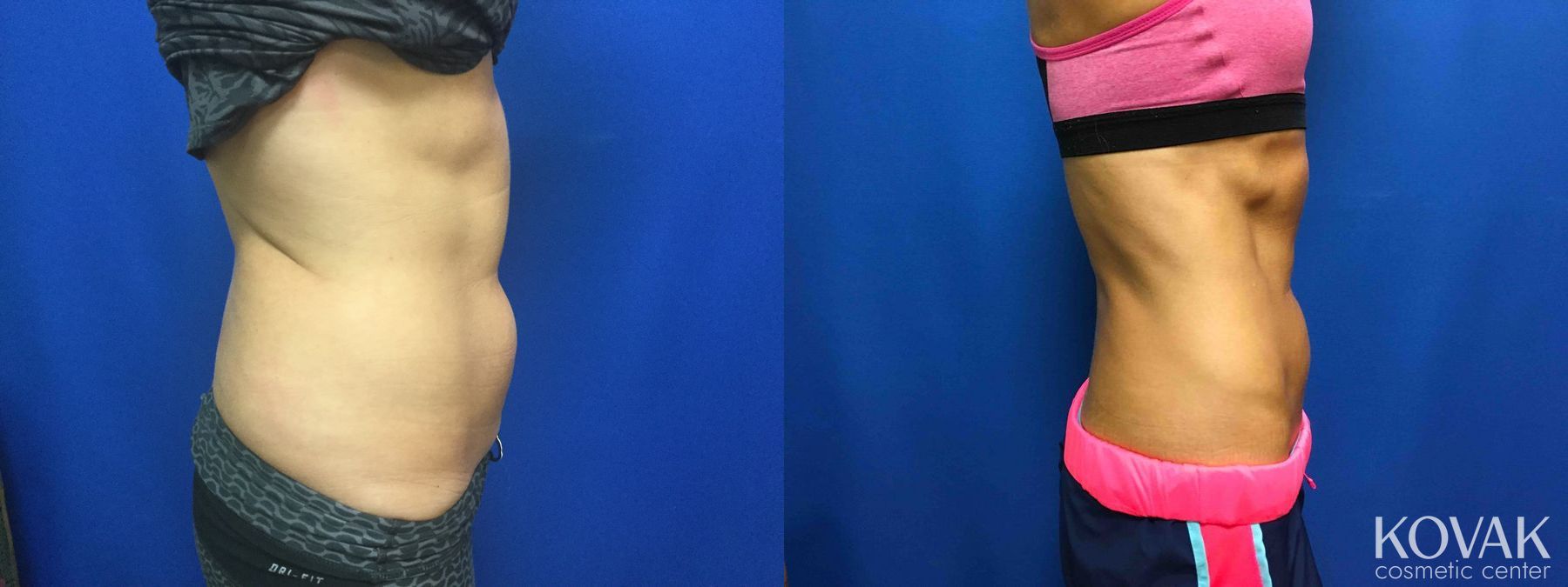 Before and after CoolSculpting® case 36666 - Angle 3