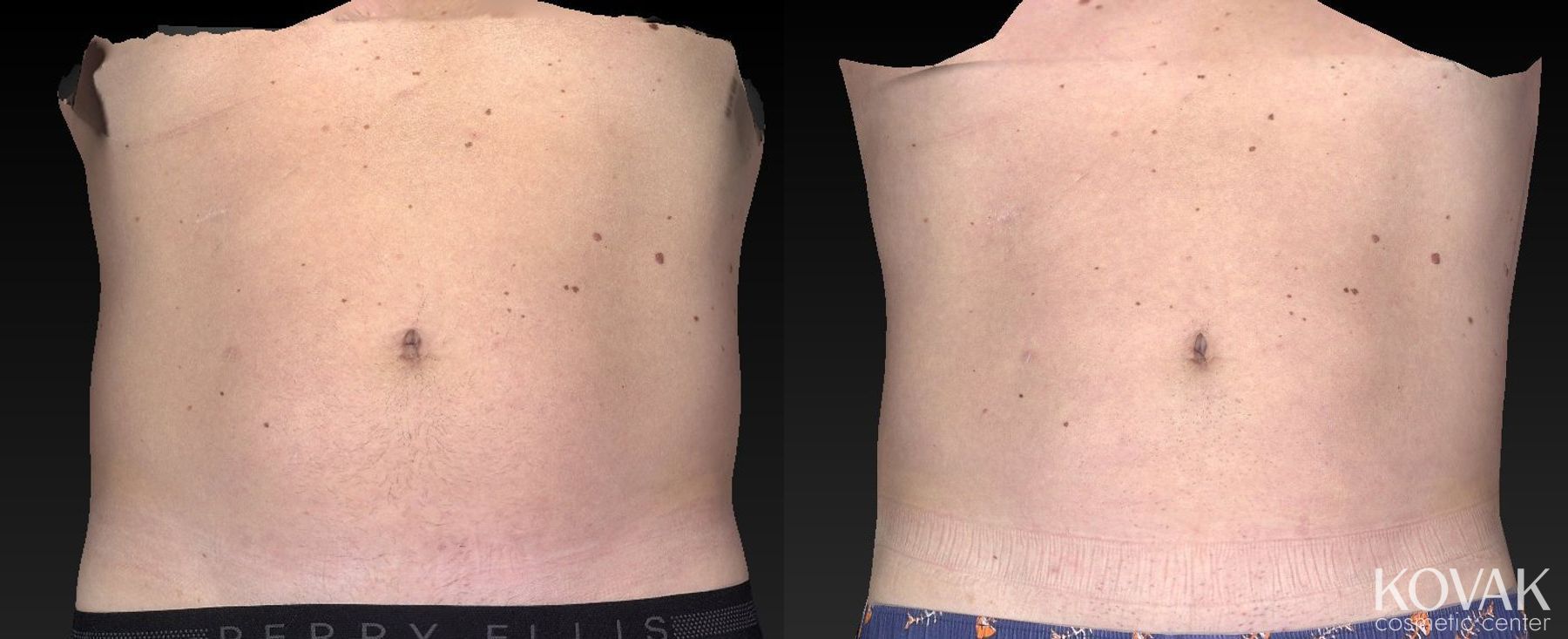 Before and after CoolSculpting® case 36555