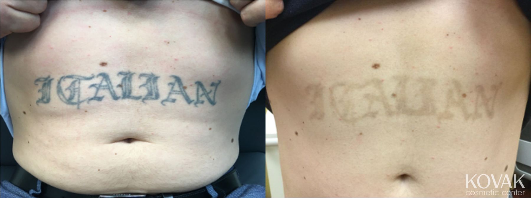 Before and after Tattoo Removal case 36489