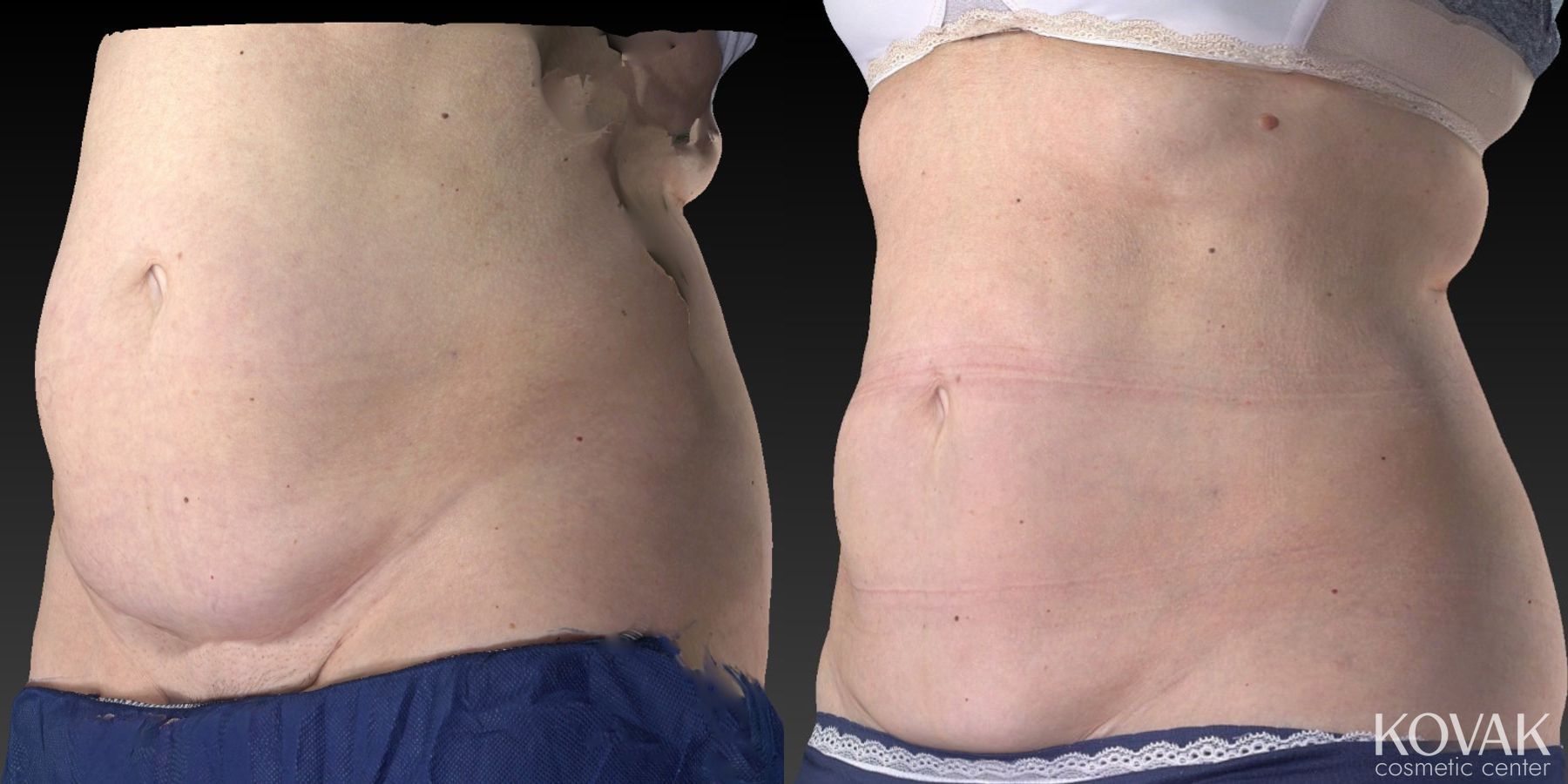 Before and after CoolSculpting® case 36564 - Angle 2