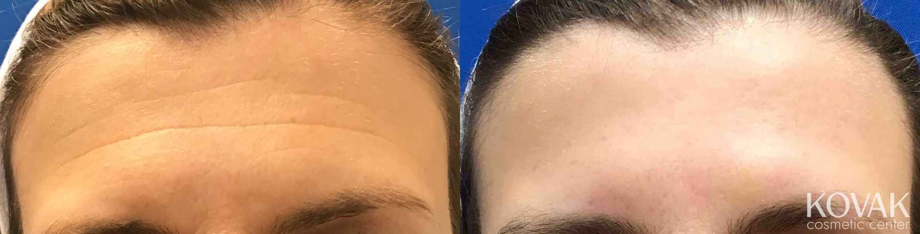 Before and after Injectables case 36628