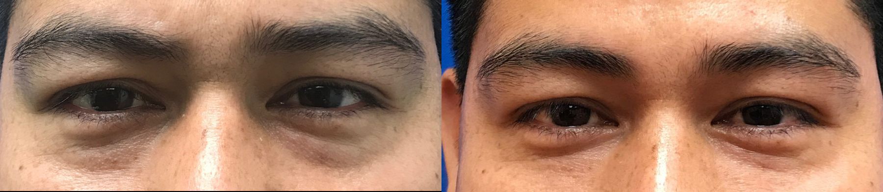 Before and after Restylane® case 36588