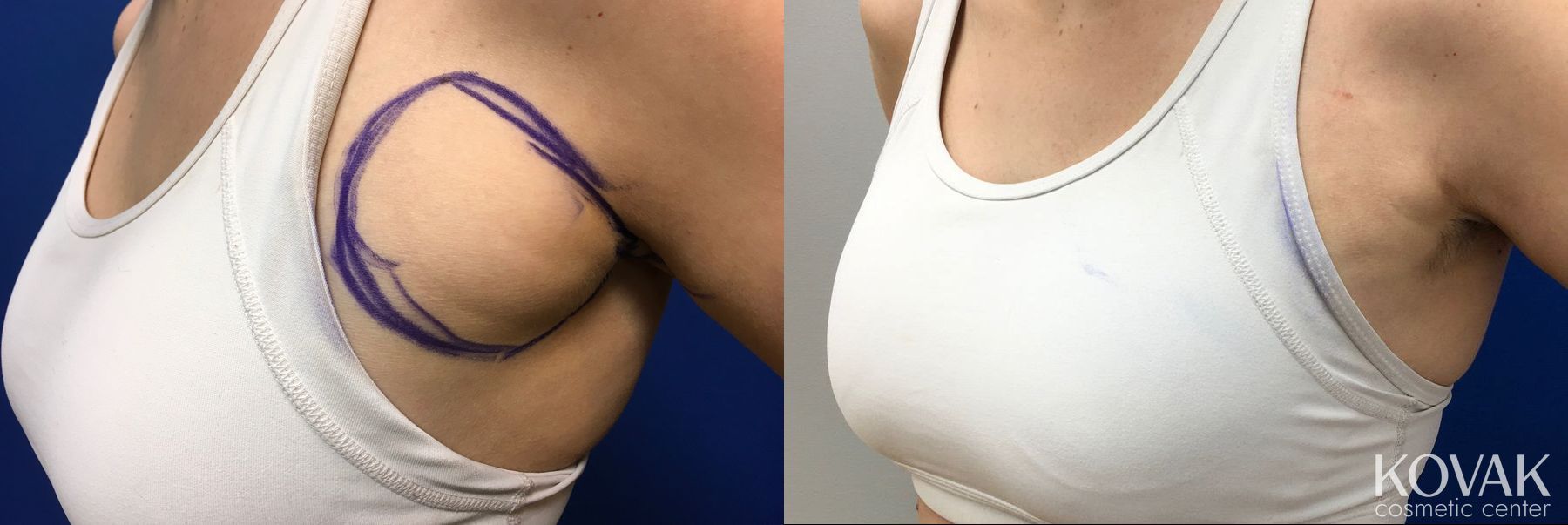 Before and after Laser Liposuction case 36663
