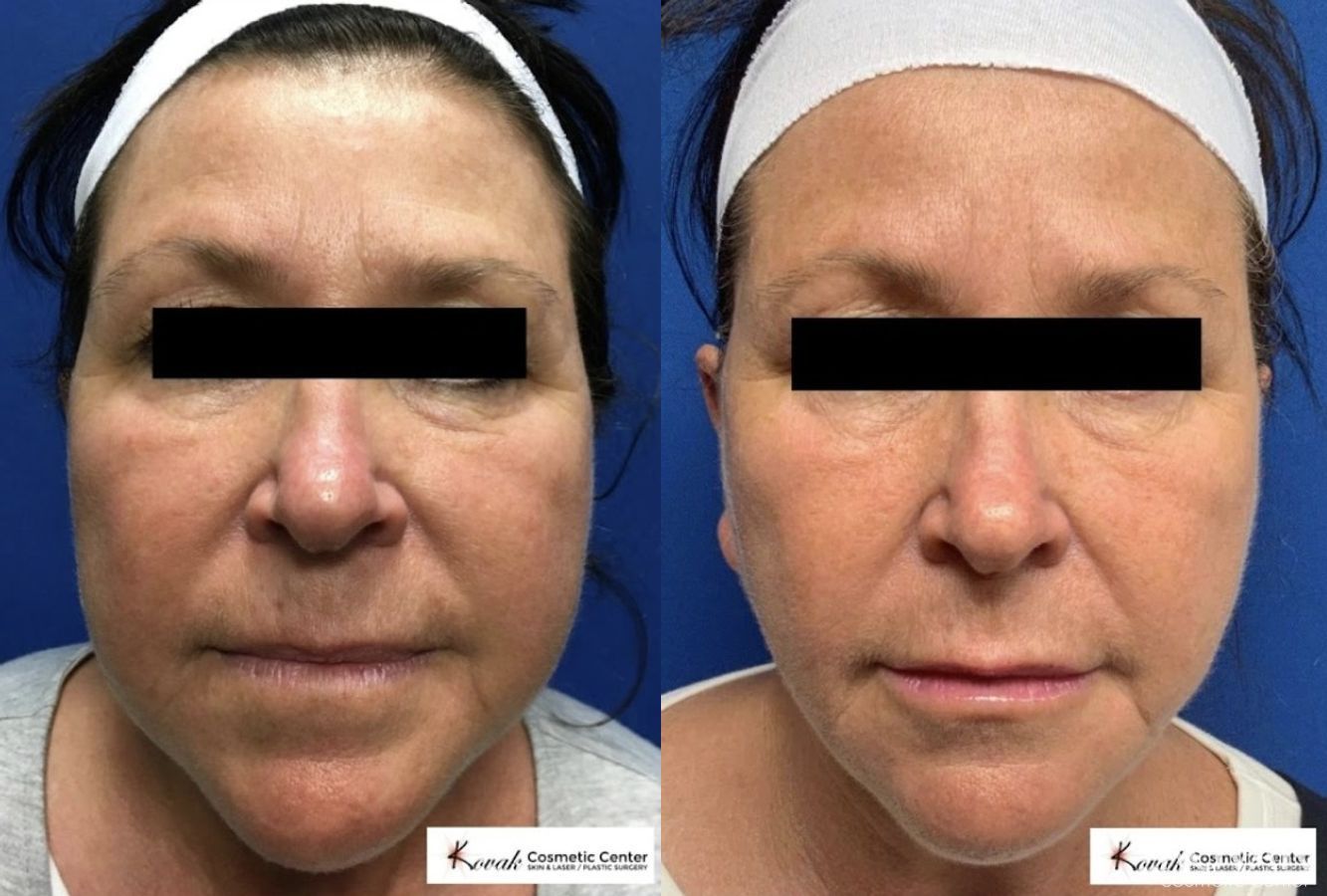 Before and after VLR - Vaser Laser - Jawline Sculpting case 36760 - Angle 2