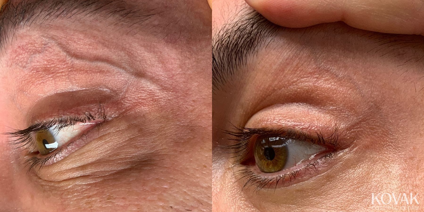 Before and after Eye Vein Treatment case 36744 - Angle 3