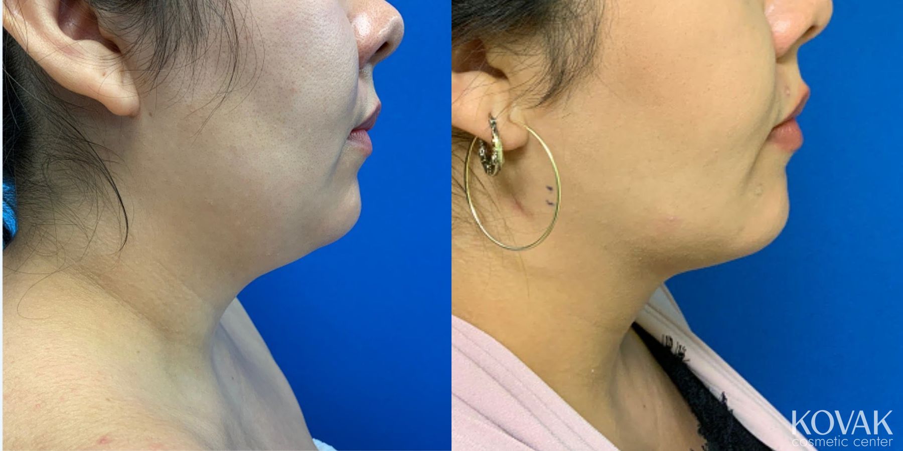 Before and after VLR - Vaser Laser - Jawline Sculpting case 36761 - Angle 2