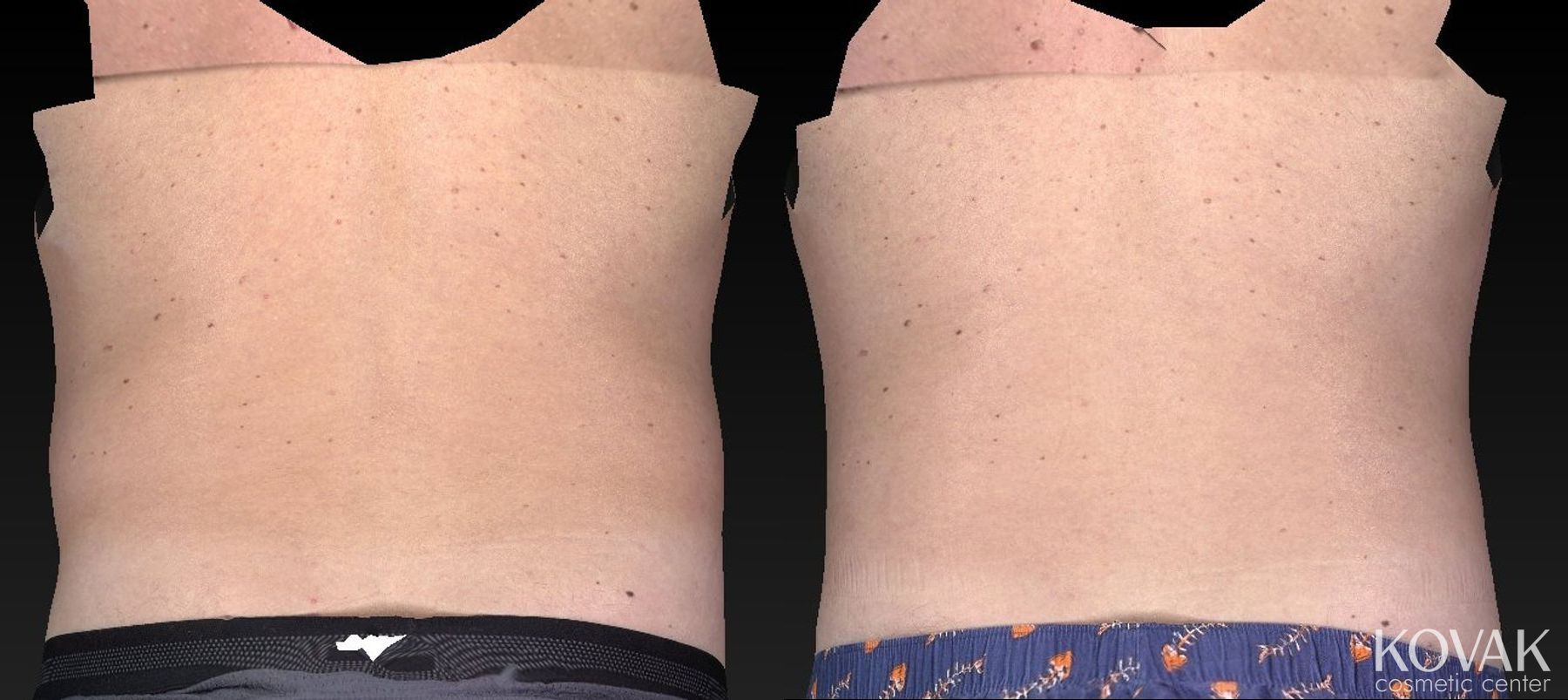 Before and after CoolSculpting® case 36555 - Angle 3