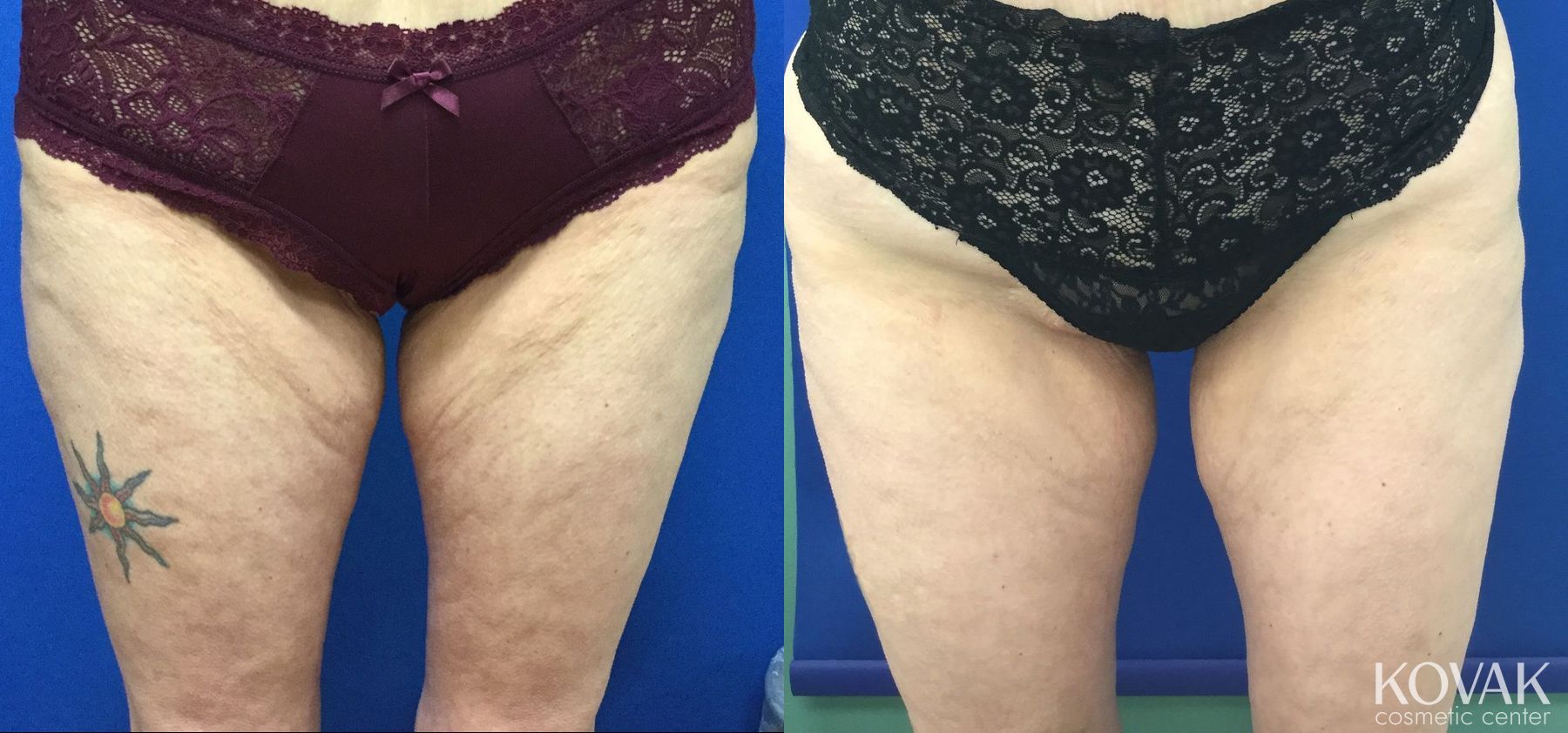 Before and after EMSCULPTĀ® case 36685