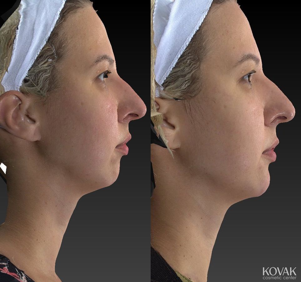 Before and after Restylane® Lyft case 36582