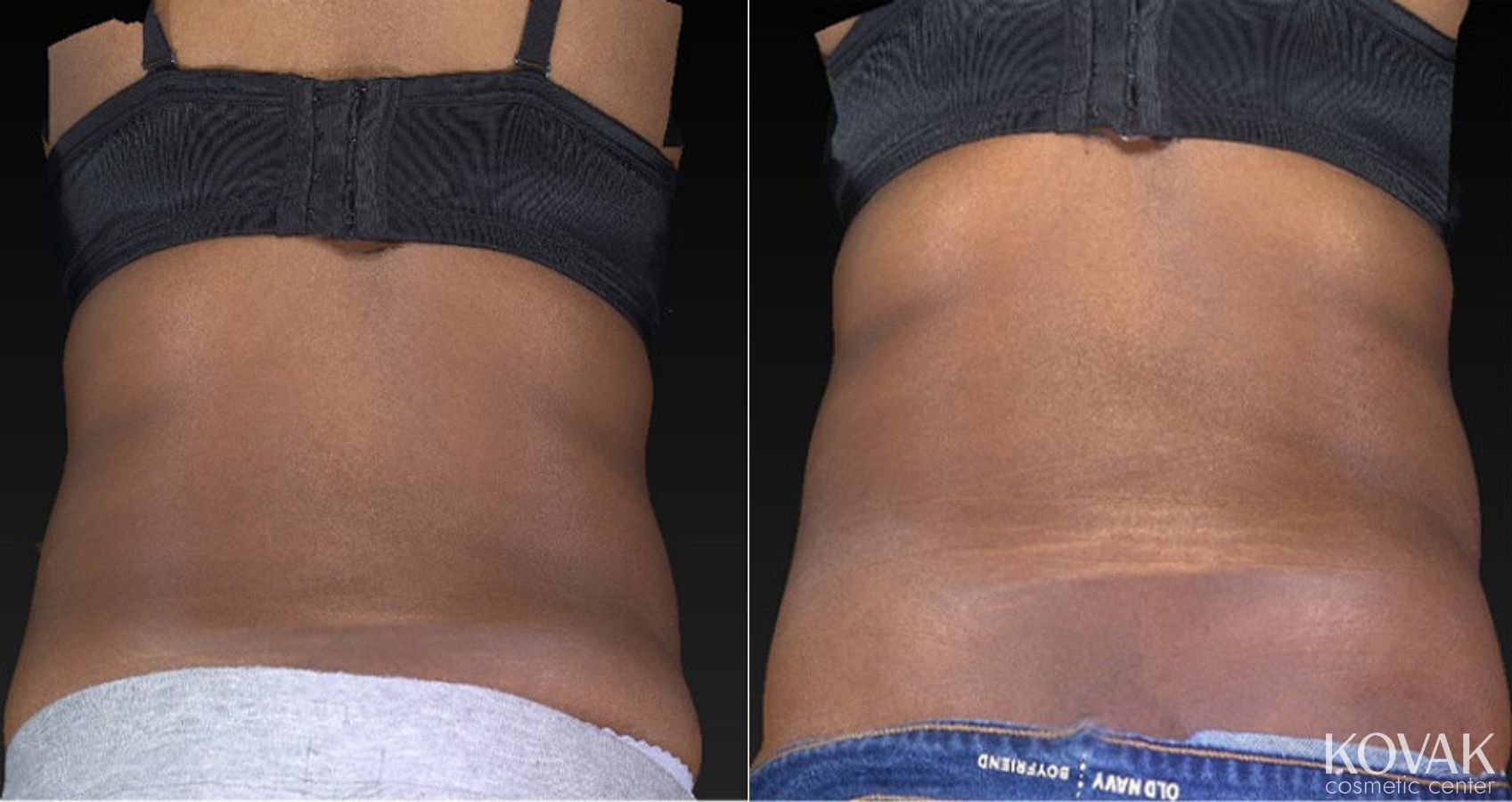 Before and after CoolSculpting® case 36505 - Angle 2