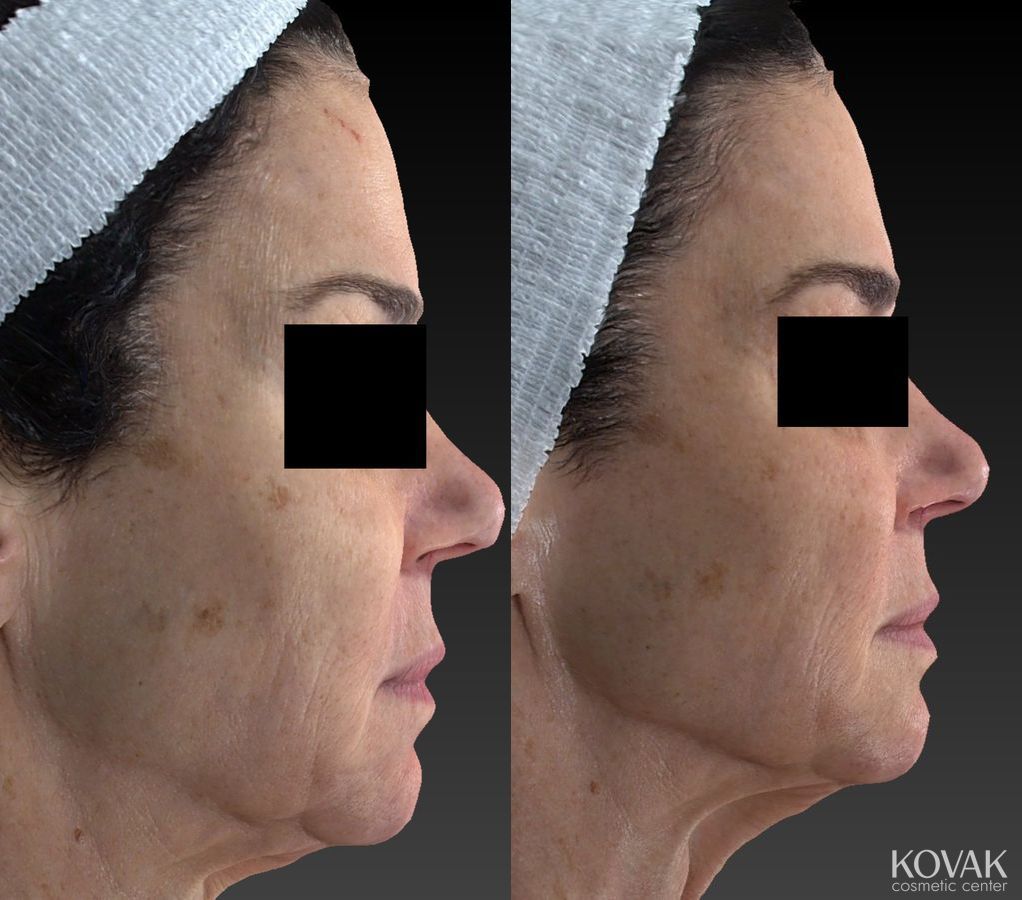 Before and after Halo™ case 36585