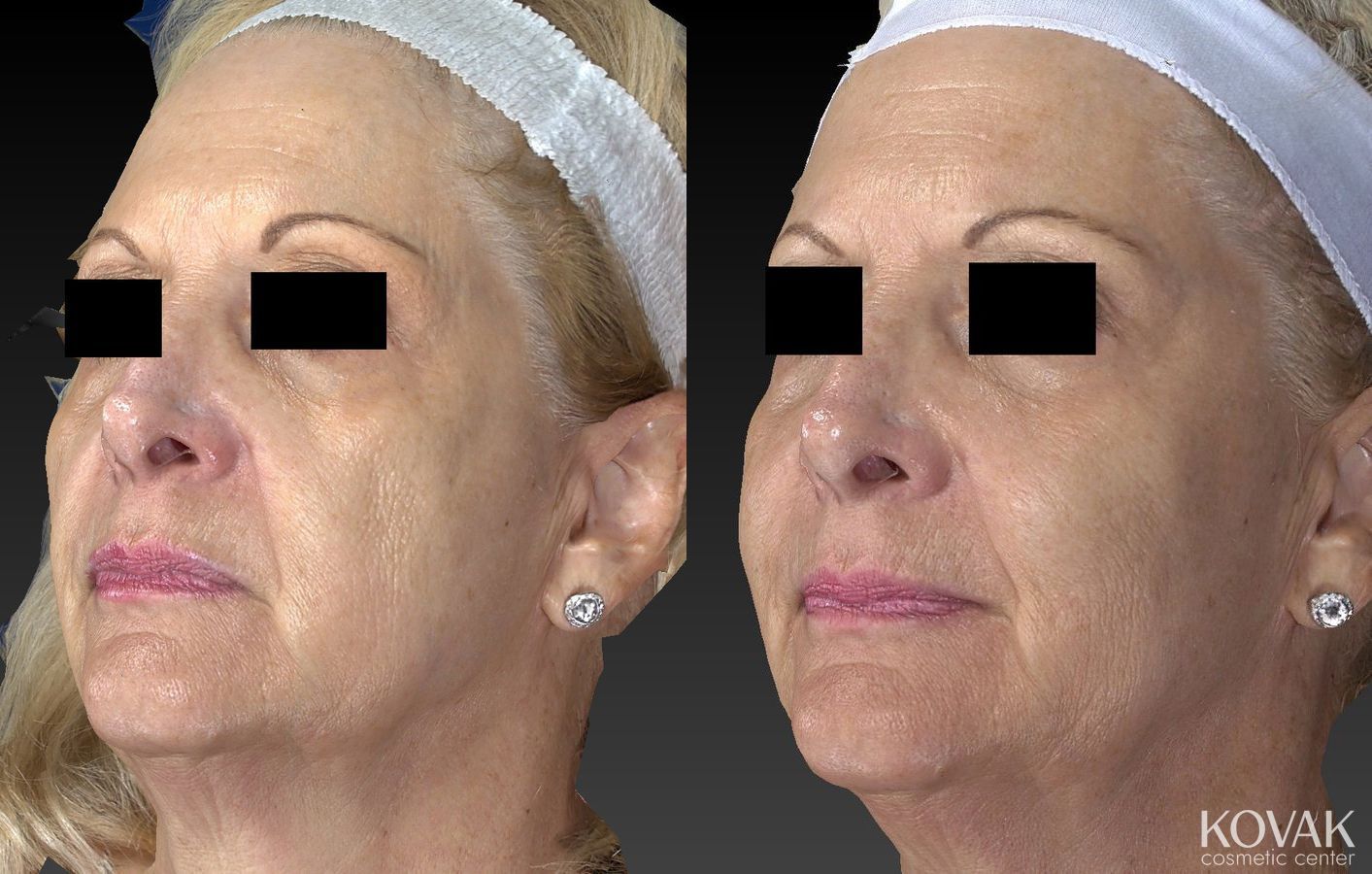 Before and after Sculptra® case 36618 - Angle 4