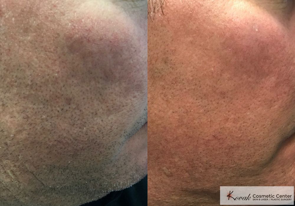 Acne Scars - Case 1568