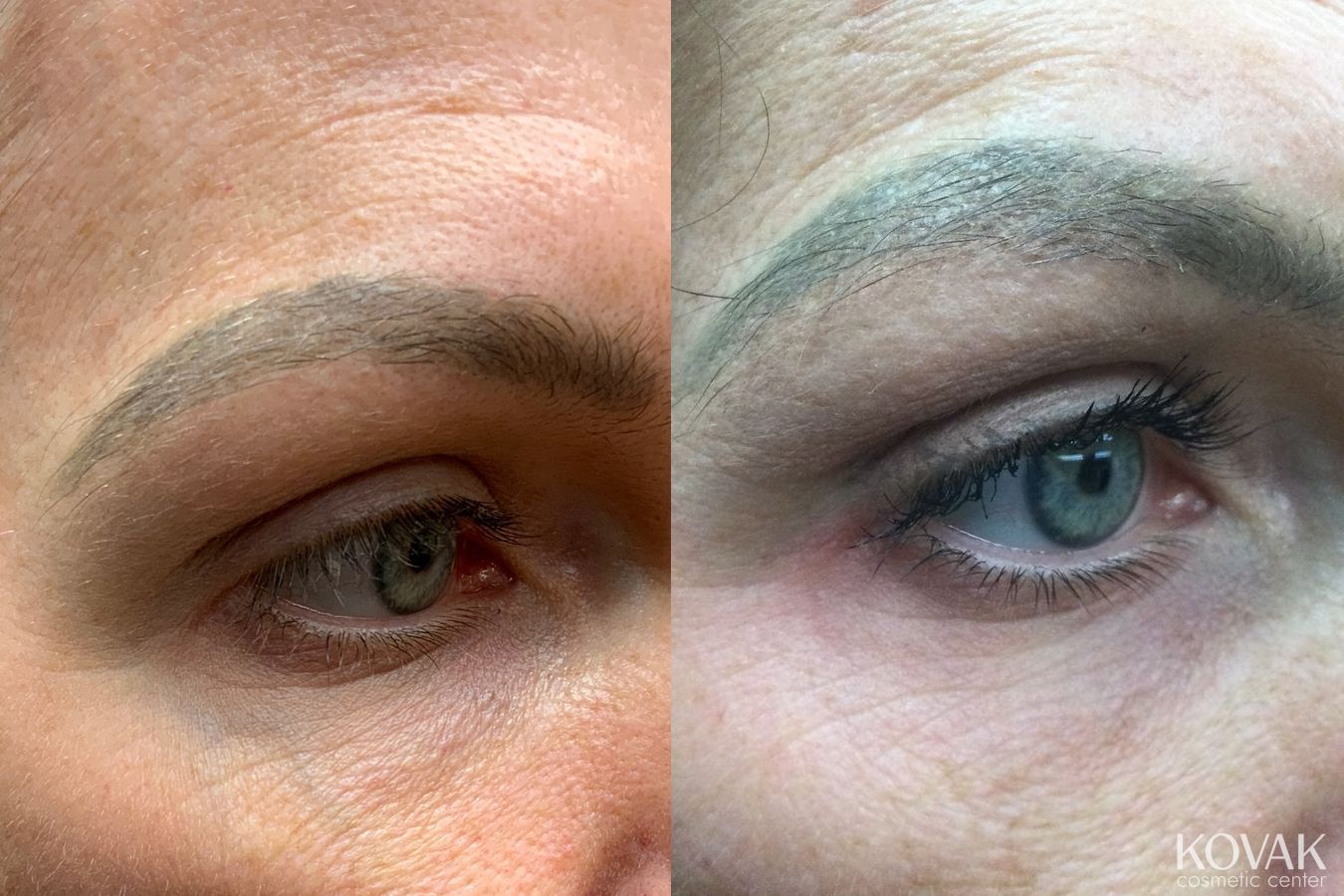 Before and after Eye Vein Treatment case 36452