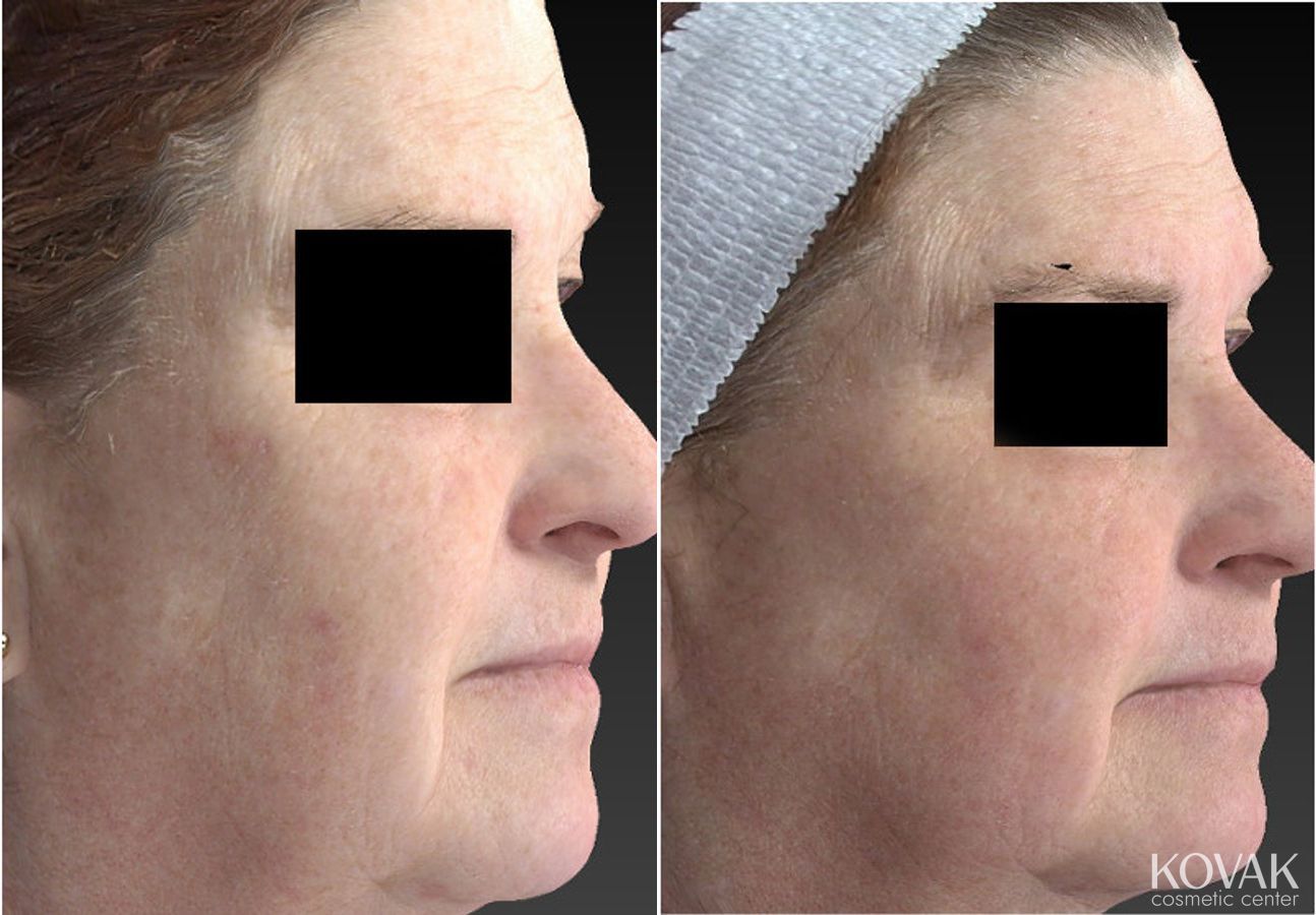 Before and after Halo™ case 36473 - Angle 3