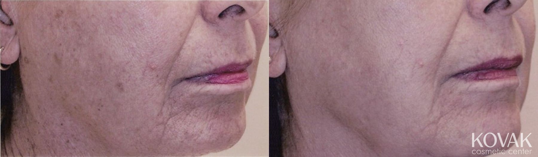 Before and after Tyte and Bryte Photorejuvenation case 36688