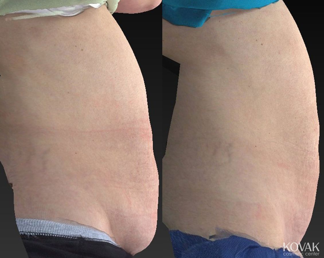 Before and after CoolSculpting® case 36459 - Angle 3