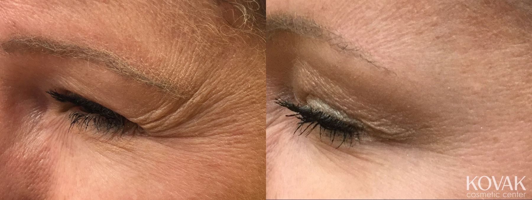 Before and after BOTOX® Cosmetic case 36519