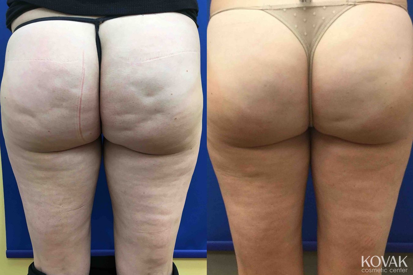 Before and after Cellulite Reduction case 36629
