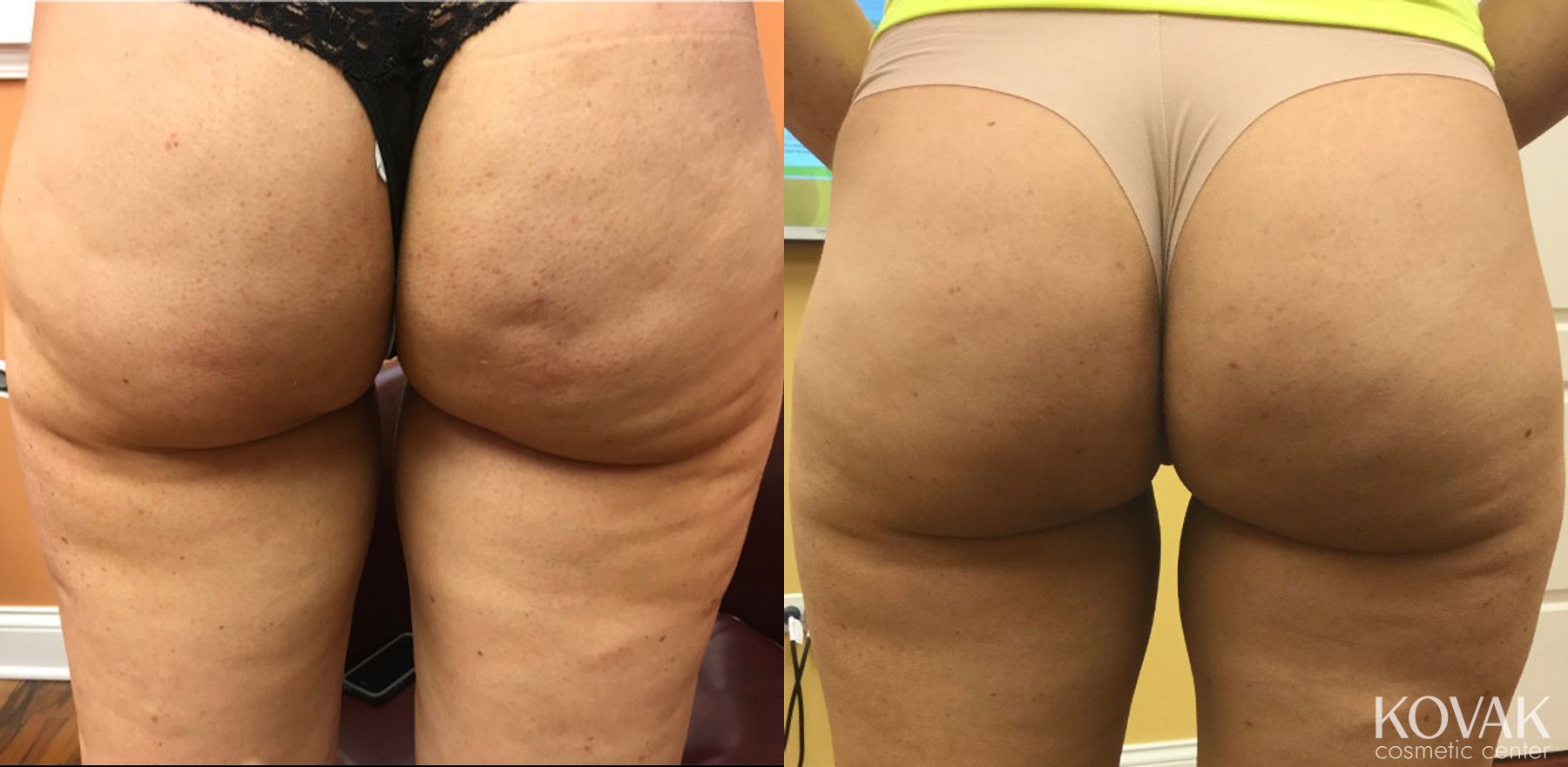 Before and after Cellulite Reduction case 36523