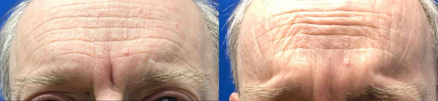 Before and after Juvéderm® XC case 36631